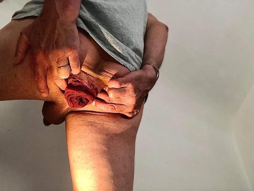 Tüh rektumum dışarı çıktı - anal prolapsus