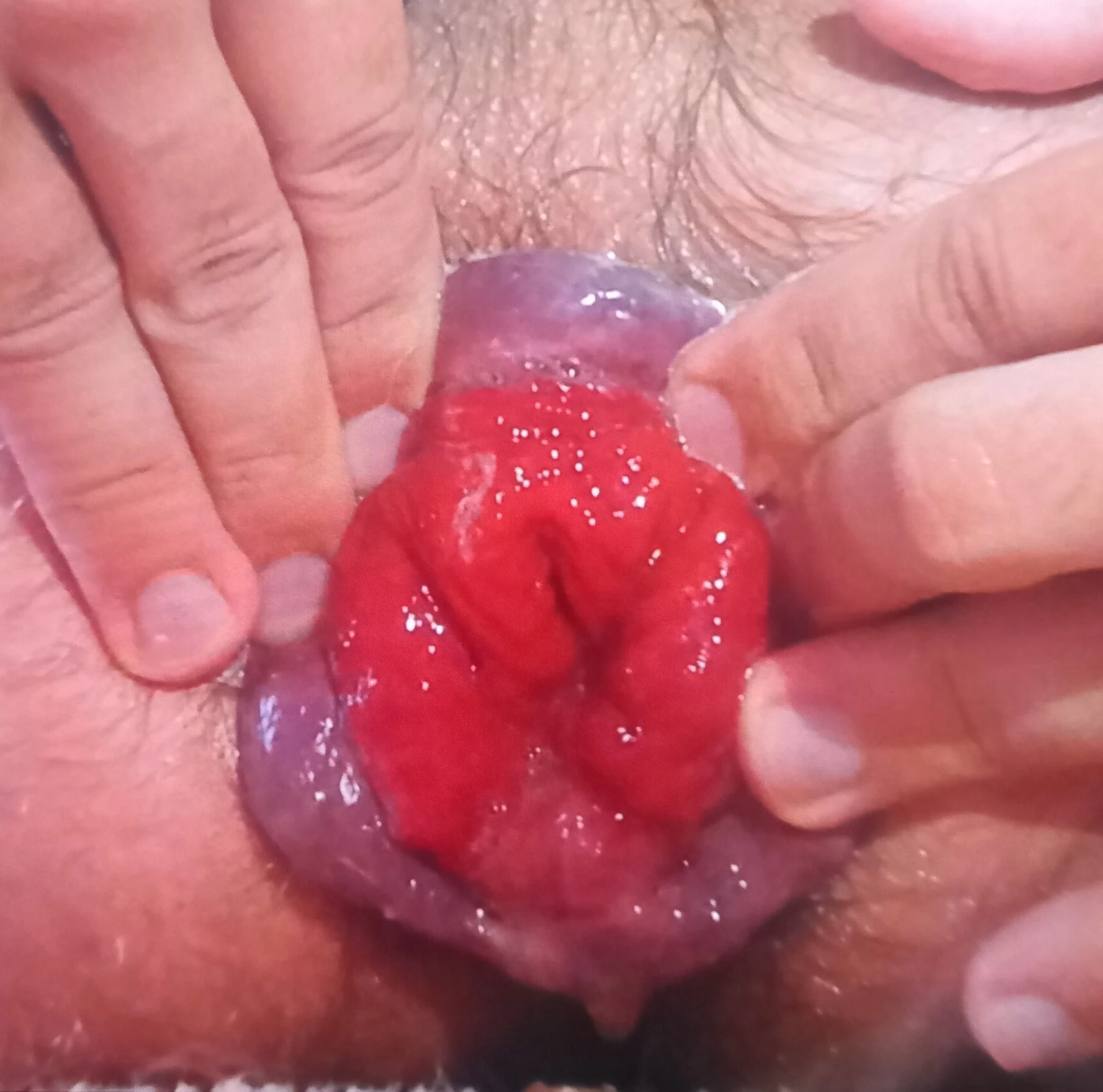 Gül anal sarkması