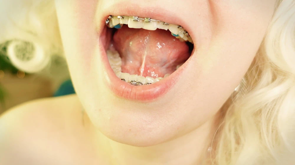 braces! #4