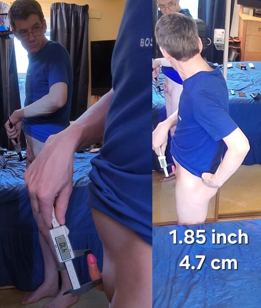 1.85 inç (4.7 cm) dik mikropenis sert yarak ölçüldü