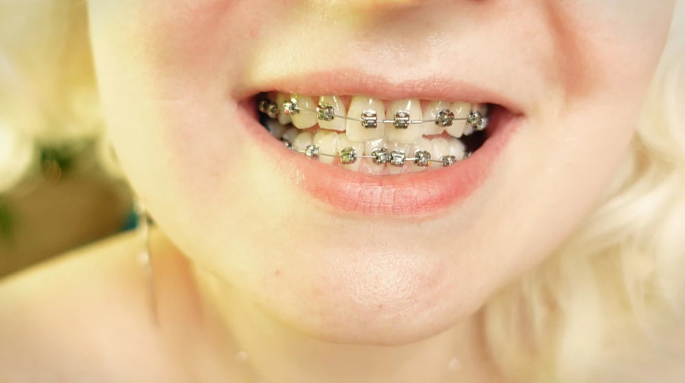 braces! #3