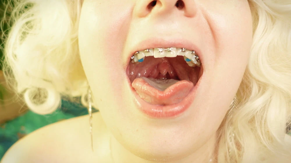 braces! #2