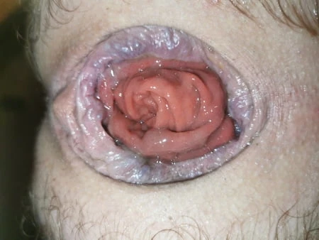 prolapsus