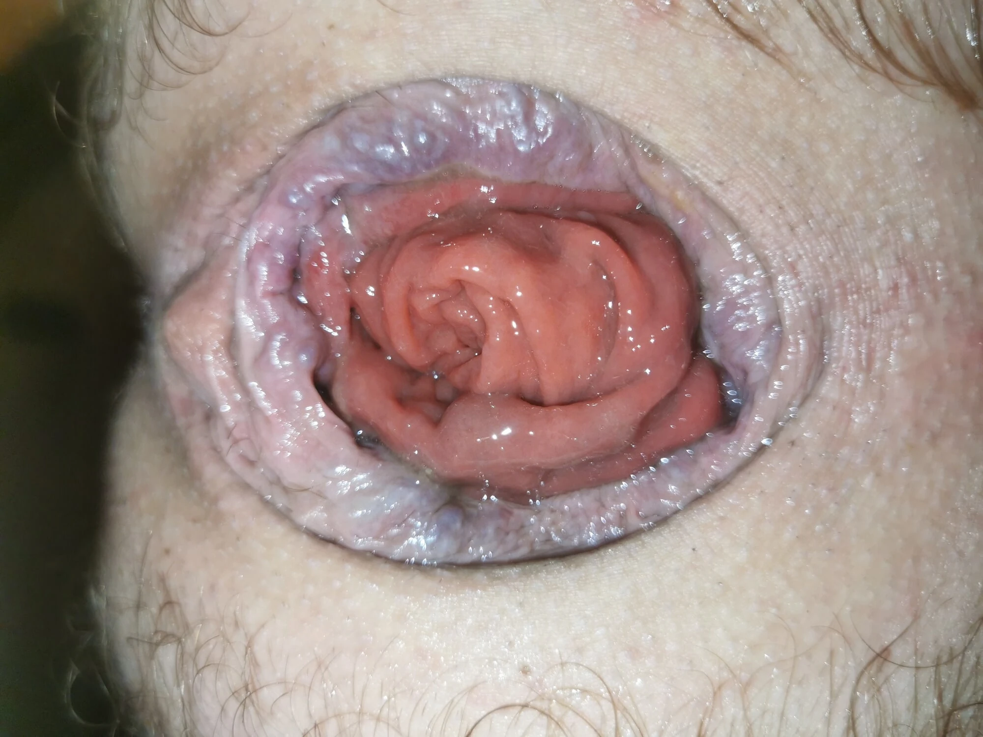 prolapsus